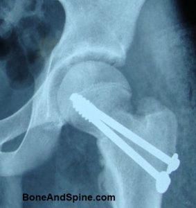 United Fracture Neck of Femur With Cannulated Screws in Situ