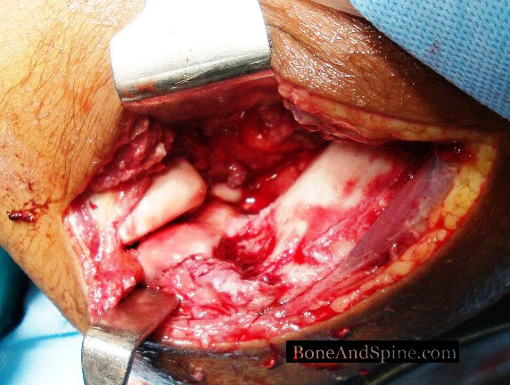 Perop Photograph after fixation of fracture of capitellum