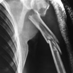 Comminuted Segmental Fracture of Humerus
