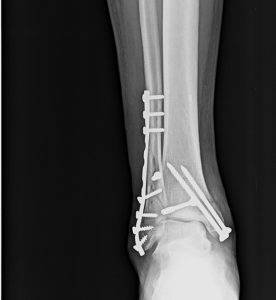 anteroposterior xray of ankle showing operated fracture bimalleolar.