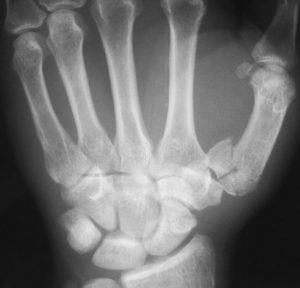 Rolando Fracture