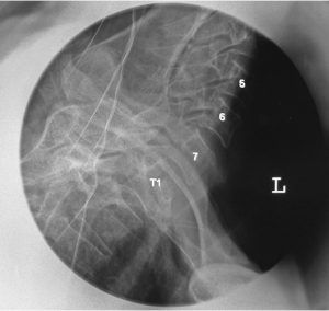 Swimmer's View - Arms Up Down Xray