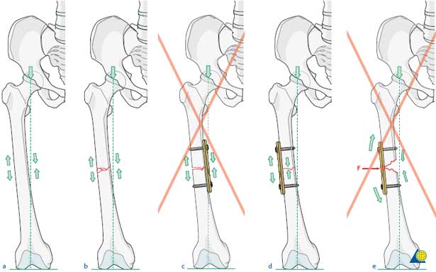 Agnes Gray converteerbaar rechtdoor Tension Band Principle and Its Applications | Bone and Spine