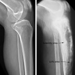 Normal bone and Bone in Paget Disease