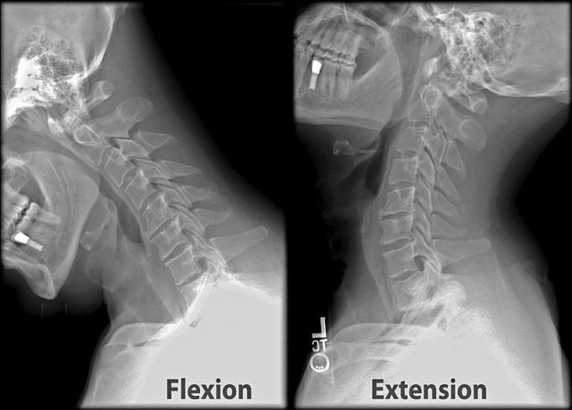 Cervical Spine Ranges of Motion (ROM) - Learn Muscles