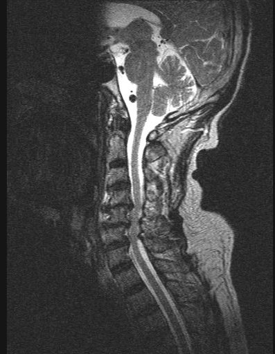 MRI showing Cervical Spondylotic Myelopathy