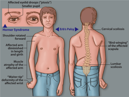 erbs-palsy.png#s-500,375