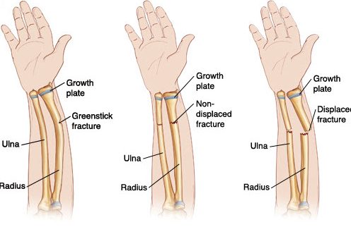 Greenstick Fractures Presentation and Treatment Bone and Spine