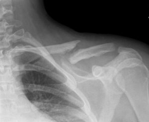 non-union-of-fracture-clavicle