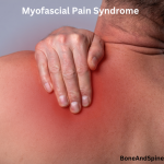 myofascial pain syndrome