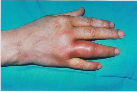 Gonococcemia Rash