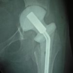 Spacer for Prosthetic Joint Infection