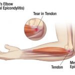 Medial Epicondyltis or Golfers elbow
