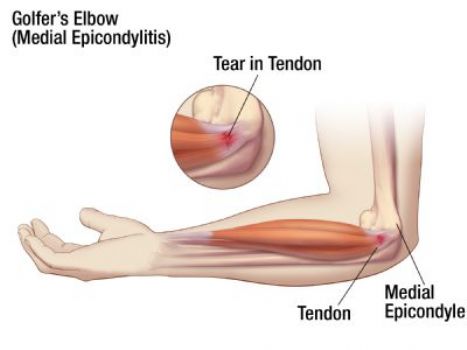 Elbow Pain Causes And Treatment Bone And Spine