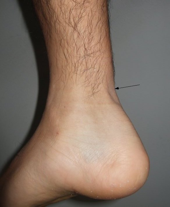 signs of a strained achilles tendon