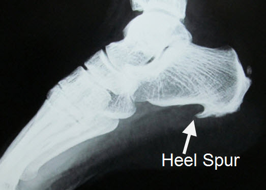 calcaneal spur xray