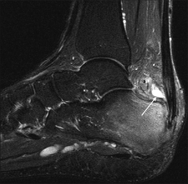 Retrocalcaneal Bursitis - Causes and 