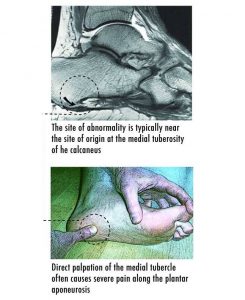 Site and Sign of Plantar Fascia