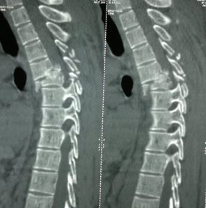 CT of Spine InjuriesD4-D5