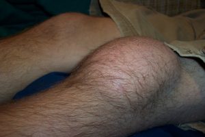 prepatellar-bursitis-image