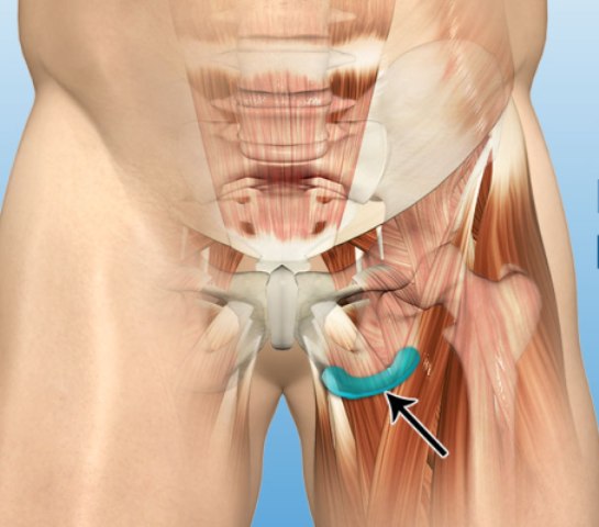 https://boneandspine.com/wp-content/uploads/2015/06/Ischial-Bursitis.jpg