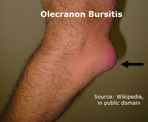 infected olecranon bursitis