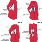 popliteal artery entrapment syndrome classification