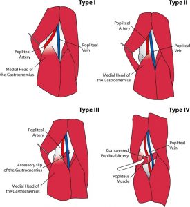 popliteal-artery-entrapment-syndrome-classification