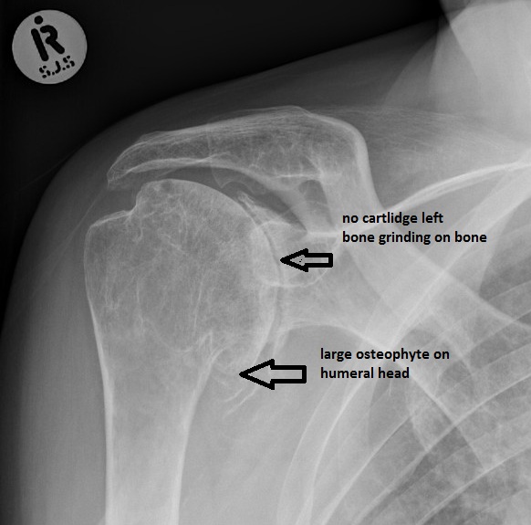 glenohumeral joint degeneration