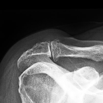 Acromioclavicular Osteoarthritis