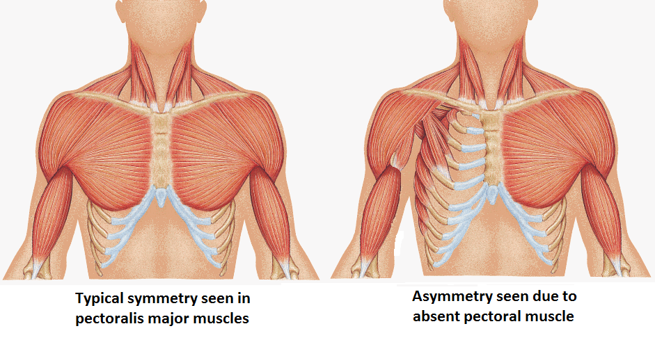 Poland Syndrome