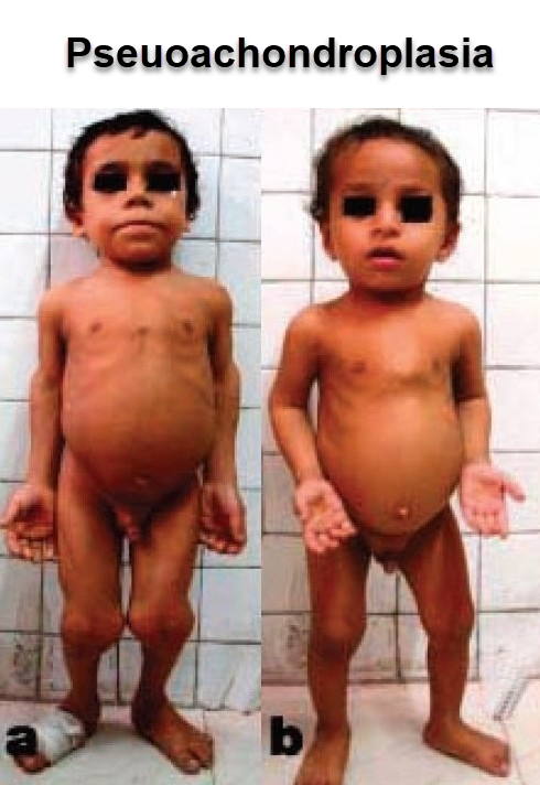 dwarfism pseudoachondroplasia