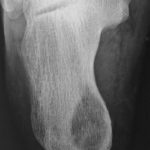 Tuberculosis of foot, calcaneum osteolytic variety