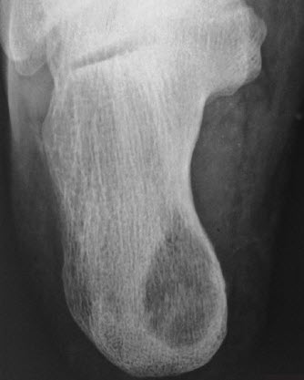 Tuberculosis of foot, calcaneum osteolytic variety