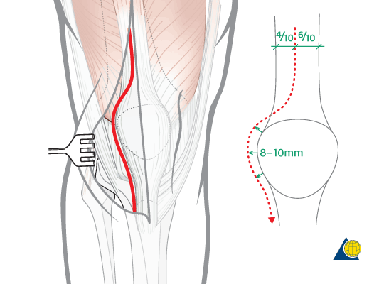 Anterior approach to synovectomy knee