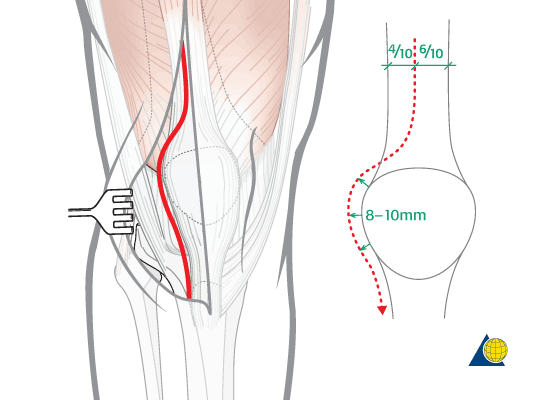 Arthrotomy Definition