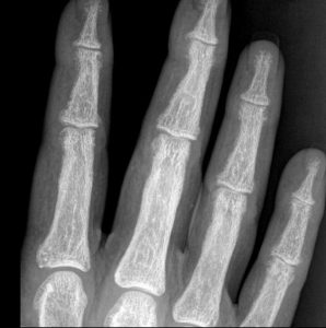 Subperiosteal bone resorption and tuft . Not the radial side concavity on distal phalanges showing subperiosteal resorption. Noted in cae of primary hyperparathyroidism