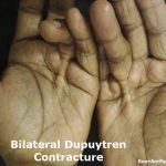 Bilateral Dupuytren Contracture
