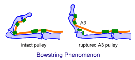 Bowstring phenomenon