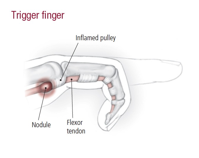 Trigger finger as a cause of hand pain