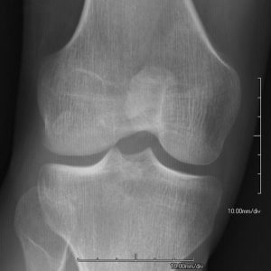 Xray of knee showing hypoplastic patella in nail patella syndrome