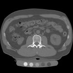 qCT or quantitative computed tomography vertebra