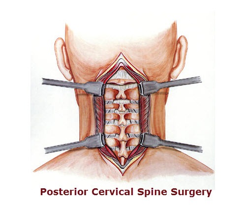 Illustration of Posterior cervical spine surgery