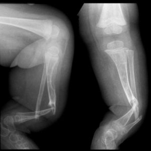 congenital pseudarthrosis of tibia associated with NF1