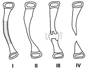 crawford classification of pseudarthrosis of tibia. Image credit: JBJS