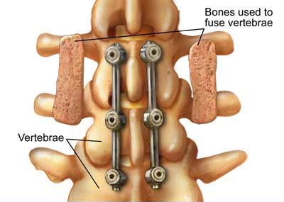 Lumbar spine surgery