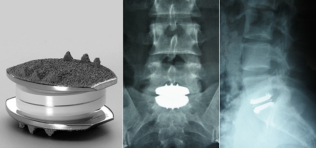 charite disc and xray. One of the motion preservation surgeries