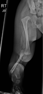 Congenital Absence of Tibia