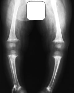 Another x-ray showing cupping, splaying and fraying