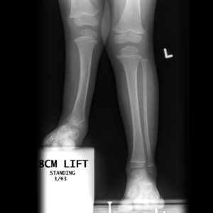 Standing xray in fibular hemimelia